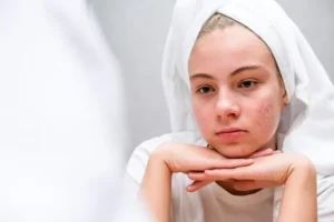 Acne: What It Is, What Are The Symptoms, Causes And Treatment