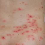 Chickenpox: What It Is, What Are The Symptoms And How To Cure It