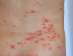 Chickenpox: What It Is, What Are The Symptoms And How To Cure It