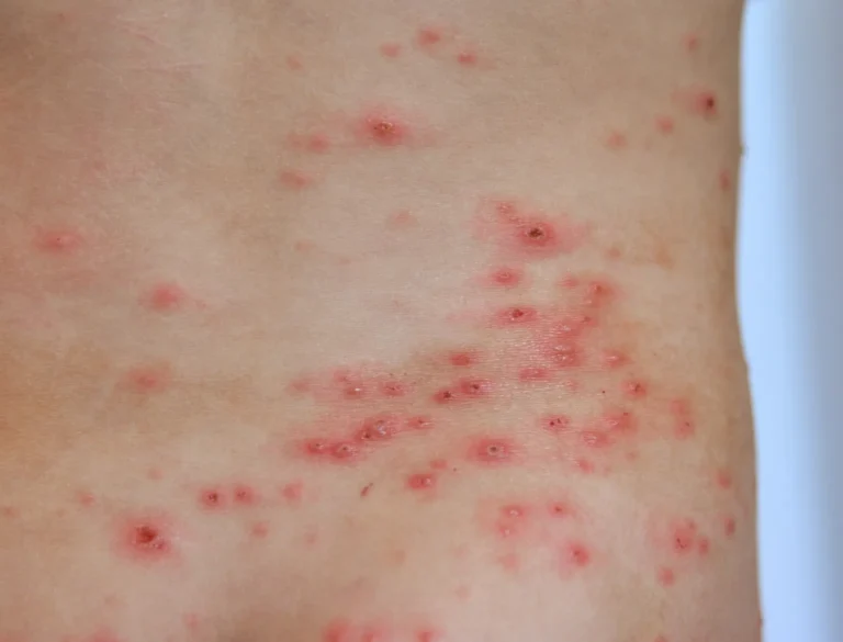 Chickenpox: What It Is, What Are The Symptoms And How To Cure It