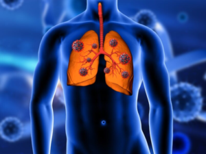 Lung cancer