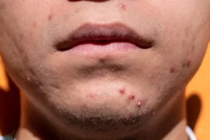 Acne: Is It Possible To Get Rid Of It At Some Point In Life Or Will It Always Be Present?