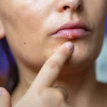 Cold Sores: What They Are, Symptoms, Causes, and Home Remedies to Soothe Them (Why Do They Call It “Fever in the Mouth”?)