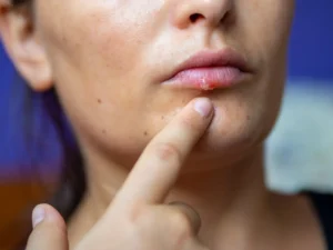 Cold Sores: What They Are, Symptoms, Causes, and Home Remedies to Soothe Them (Why Do They Call It “Fever in the Mouth”?)