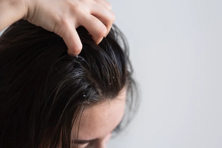 Dandruff Or Flaking?: Differences, Causes And Treatments