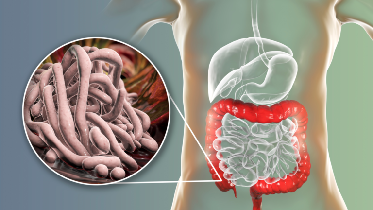 Parasites: What They Are, Symptoms, Causes, Risks, Complications And Prevention