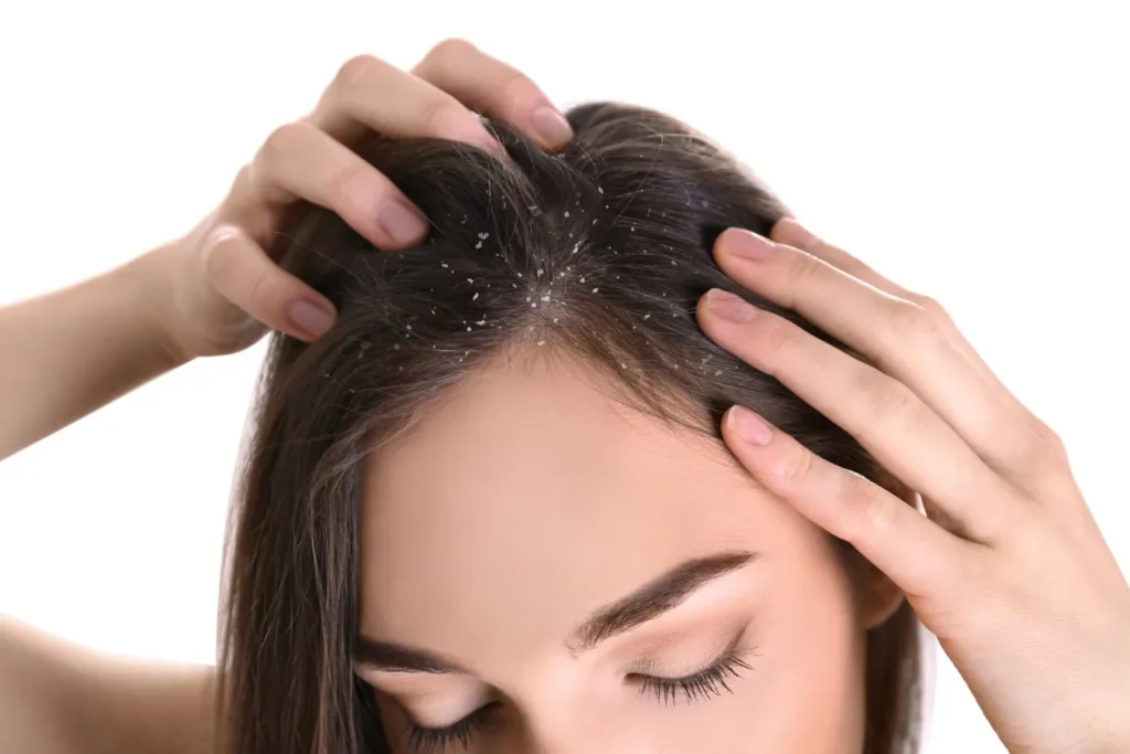 dandruff