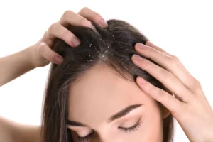 dandruff