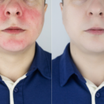 Why Does Your Face Turn Red?: The Most Common Diseases That Cause It And How To Prevent Them