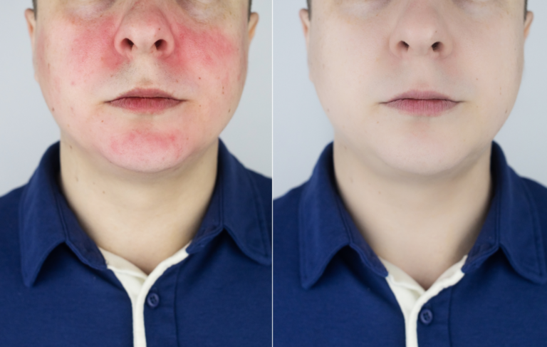 Why Does Your Face Turn Red?: The Most Common Diseases That Cause It And How To Prevent Them