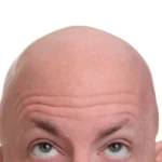 Baldness: Why Hasn’t A Cure Been Found Yet?