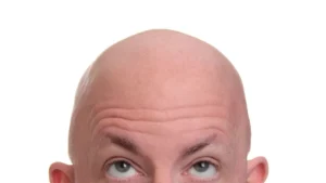 Baldness: Why Hasn’t A Cure Been Found Yet?