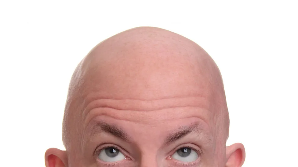 Baldness