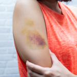 Bruises: How To Know If They Are Serious And How To Care For Them?