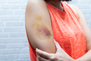 Bruises: How To Know If They Are Serious And How To Care For Them?