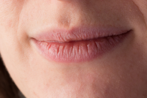 Dry Mouth? This Could Be A Sign Of Other Medical Conditions