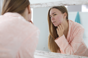 Why Acne Appears, What To Do And What Not To Do To Eliminate It