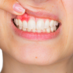 Are Your Gums Bleeding? Your Health May Be In Serious Trouble