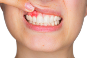 Are Your Gums Bleeding? Your Health May Be In Serious Trouble