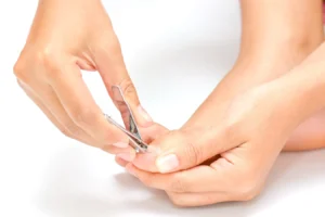 How To Treat An Ingrown Toenail And How To Prevent This Condition